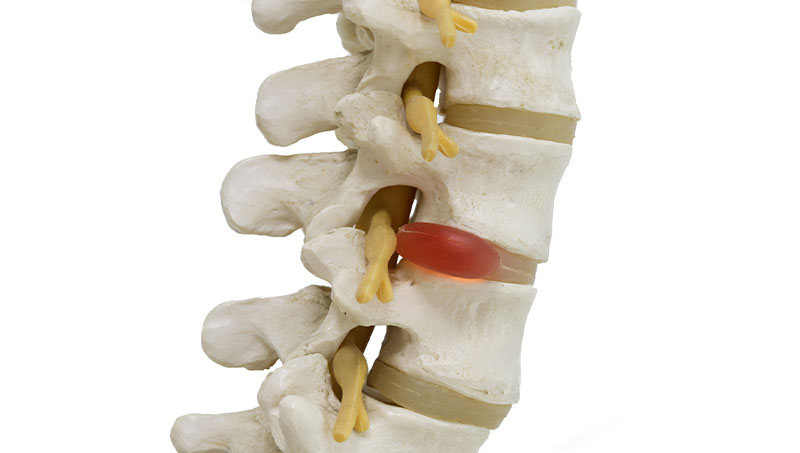 Herniated disc bulging in spinal cord