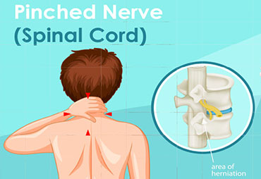 Pinched nerve care